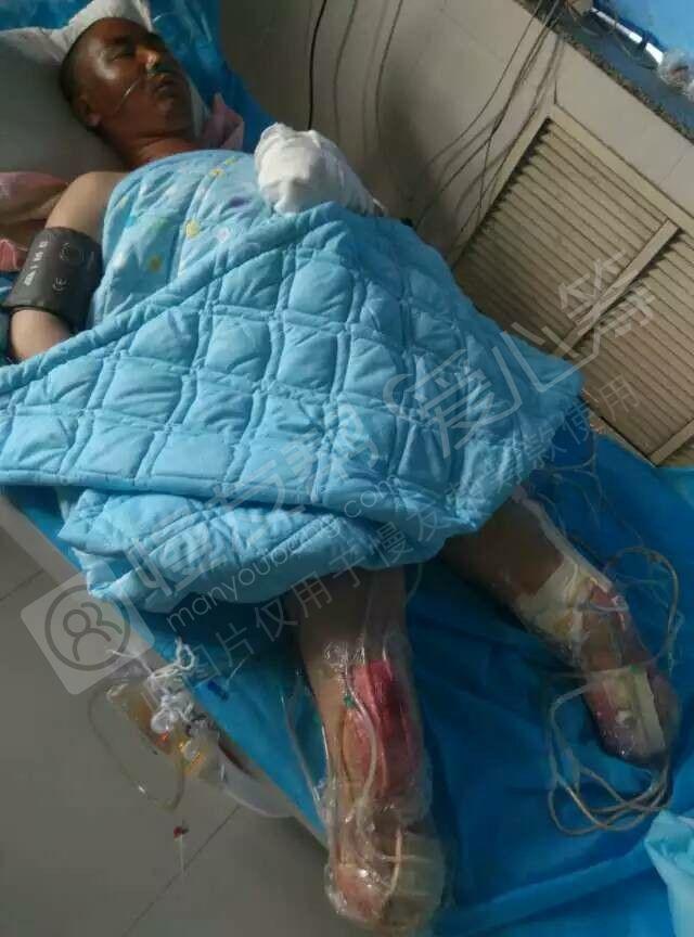 双脚截肢,身体大面积烧伤,丧失劳动能力——一个1岁半