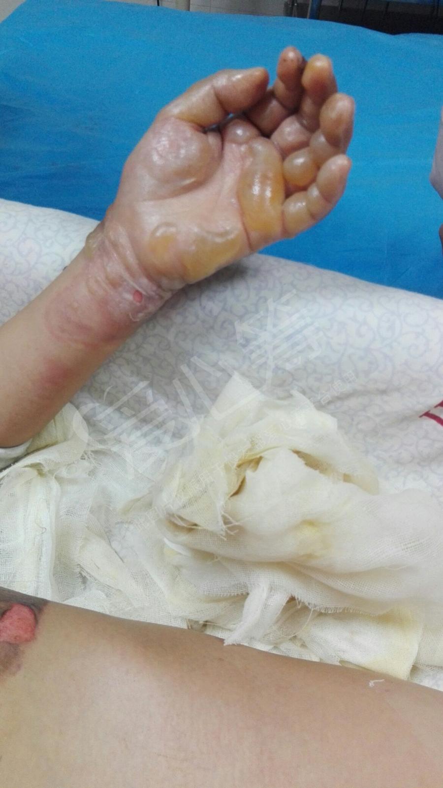 孩子被酒精烧伤须要五万的费用