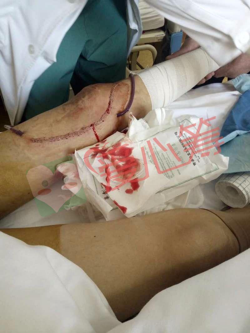 年轻小伙身患骨癌,请大家伸出爱心之手让这个家不要散