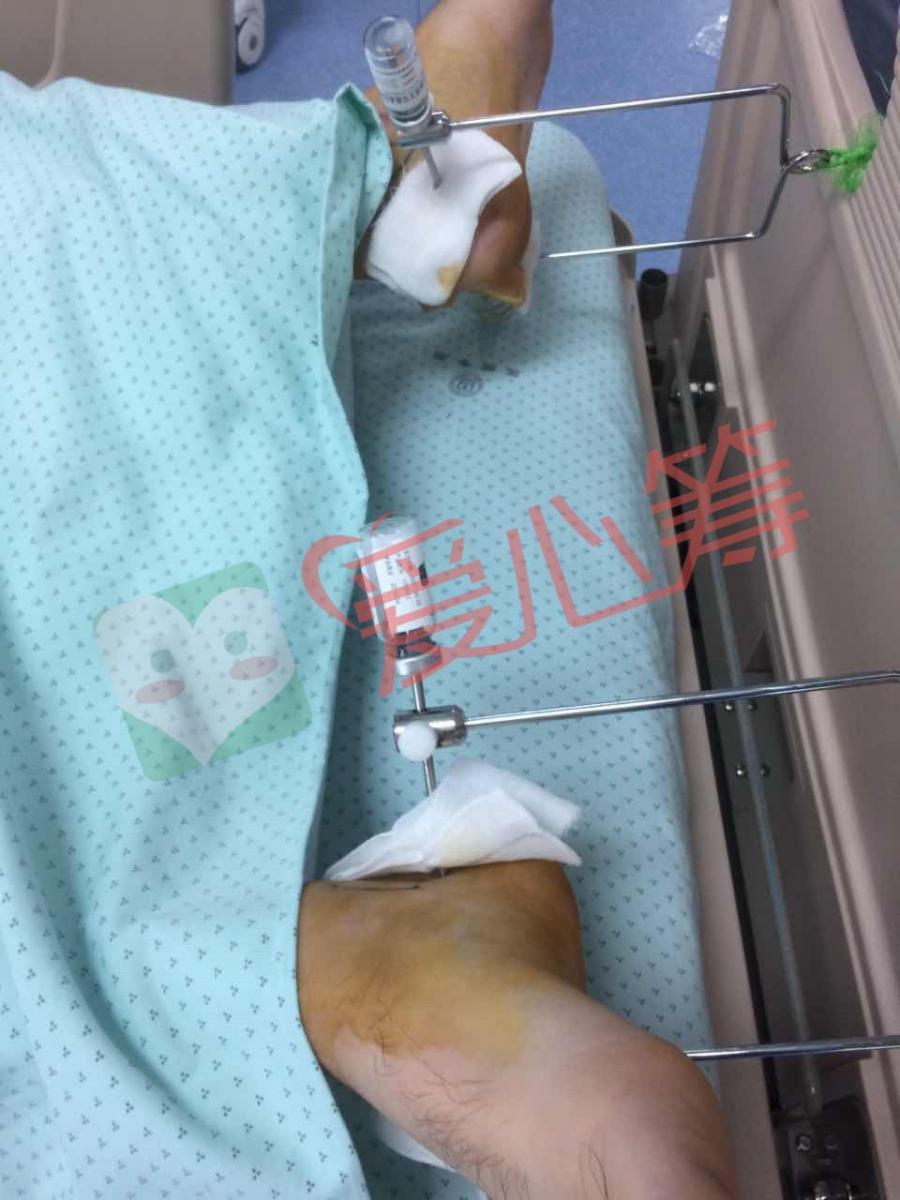 双腿骨折突发重度昏迷,转入icu重症医学科,请各位好心